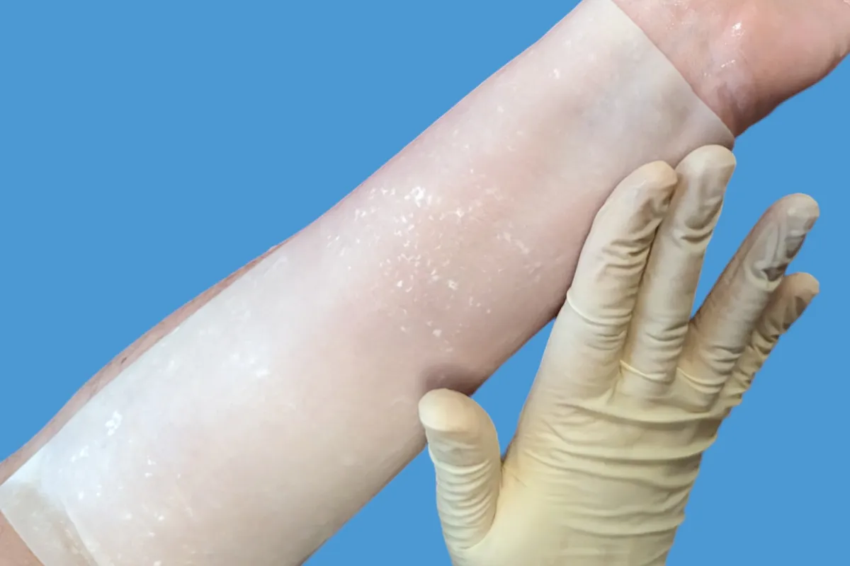 Xenoderm Dermal Matrix — Xenoderm örtüsünün ön kol üzerinde tutunma gösterimi